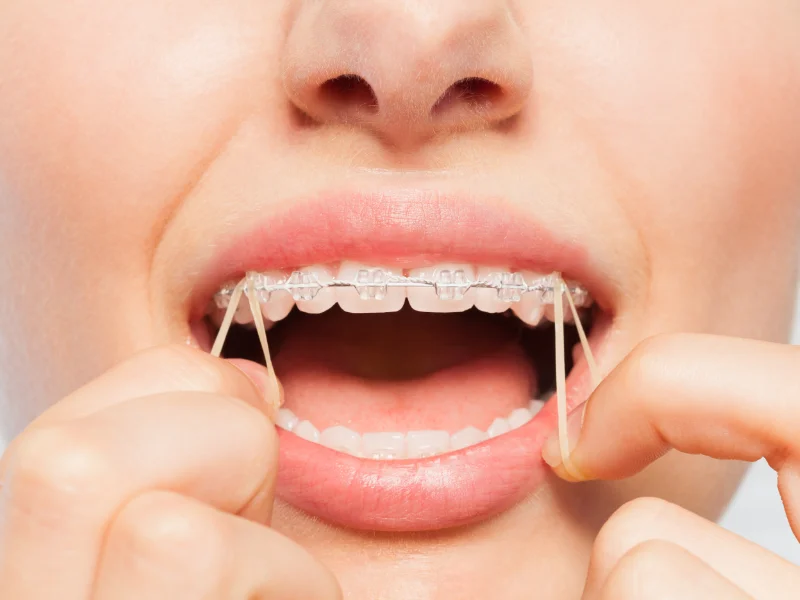elastici-in-lattice-per-ortodonzia